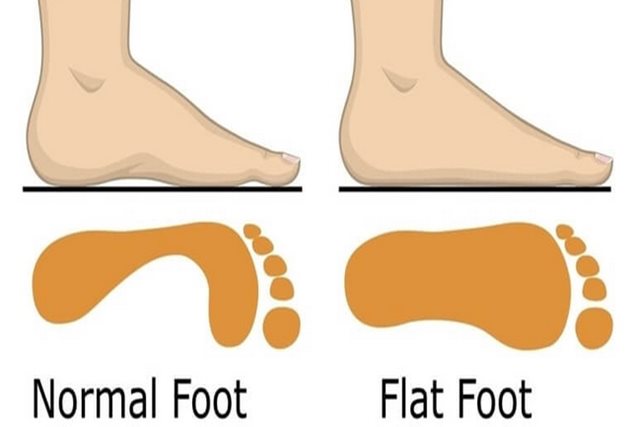 Bàn chân bẹt ở trẻ em có cần điều trị không?